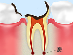 歯根に達した虫歯