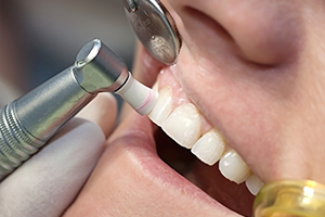虫歯・歯周病からお口の健康を守る！　クリア・デンタルクリニックの「予防歯科」
