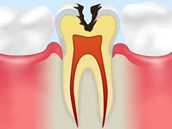 象牙質の虫歯