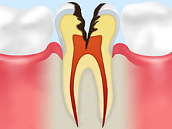 神経に達した虫歯