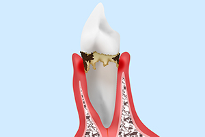 【中期】軽度歯周炎