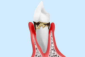 【後期】中等度歯周炎