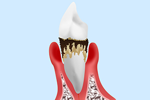 【末期】重度歯周炎