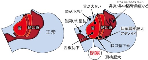 睡眠時無呼吸症候群 (OSA) とは