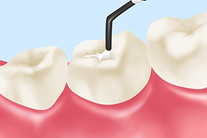 当院の予防歯科メニュー